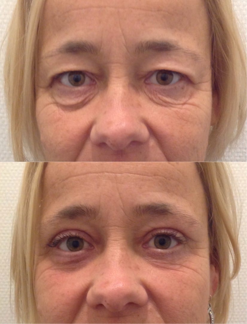 boven ooglid correctie onder ooglid correctie ooglift blepharoplastiek, hangende oogleden, ooglidcorrectie